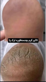 این محصول حرفهای یک ترمیمکننده مناسب برای کف پا است. مواد مؤثر منحصر بهفرد موجود در این کرم علاوه بر رفع ترکهای کف پا، پوست را آبرسانی کرده و باعث نرمی و لطافت آن میشود.