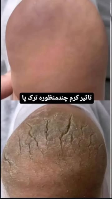 این محصول حرفهای یک ترمیمکننده مناسب برای کف پا است. مواد مؤثر منحصر بهفرد موجود در این کرم علاوه بر رفع ترکهای کف پا، پوست را آبرسانی کرده و باعث نرمی و لطافت آن میشود.